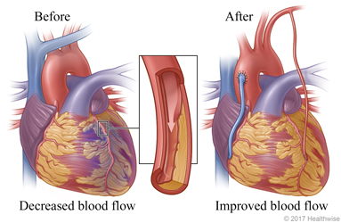 Decreased blood flow caused by narrowed or blocked artery before surgery and normal blood flow after surgery
