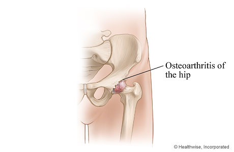 Hip joint affected by osteoarthritis