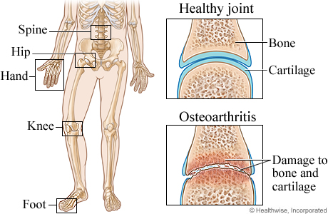 Joints commonly affected by osteoarthritis
