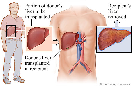 Picture of living-donor liver transplant