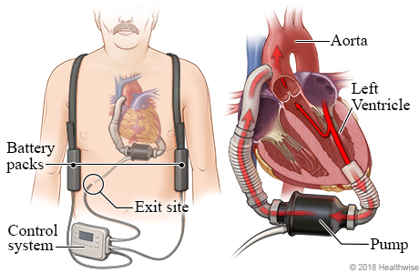 Location of VAD pump, battery packs, and controller, with detail of VAD pumping blood from heart's left ventricle to the aorta