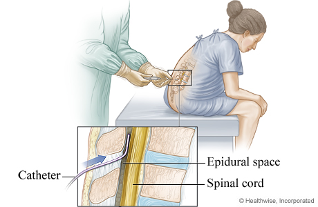 Placement of an epidural catheter for labor