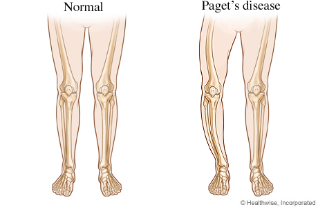 Normal legs and bowed legs from Paget's disease