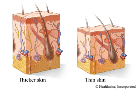 Cross section of thicker skin and thinner skin
