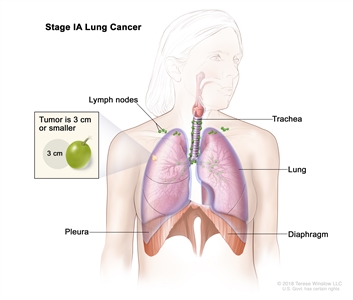 Stage IA lung cancer; drawing shows a tumor (3 cm or less) in the right lung. Also shown are the lymph nodes, trachea, pleura, and diaphragm.