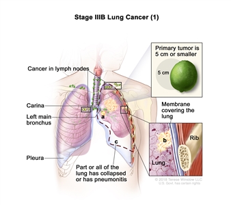 Stage IIIB lung cancer (1); drawing shows a primary tumor (5 cm or smaller) in the left lung and cancer in lymph nodes above the collarbone on the same side of the chest as the primary tumor and in lymph nodes on the opposite side of the chest as the primary tumor. Also shown is cancer that has spread to (a) the left main bronchus and (b) the membrane covering the lung. Also shown is (c) part or all of the lung has collapsed or has pneumonitis (inflammation). The carina, pleura, and a rib (inset) are also shown.