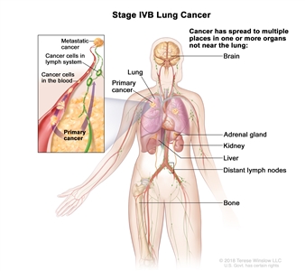 Stage IVB lung cancer; drawing shows a primary cancer in the right lung and other parts of the body where lung cancer may spread, including the brain, adrenal gland, kidney, liver, distant lymph nodes, and bone. An inset shows cancer cells spreading from the lung, through the blood and lymph system, to another part of the body where metastatic cancer has formed.
