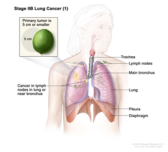 Stage IIB lung cancer (1); drawing shows a primary tumor (5 cm or smaller) in the right lung and cancer in lymph nodes in the same lung as the primary tumor. Also shown are the trachea, main bronchus, pleura, and diaphragm.