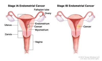 Stage IA and stage IB endometrial cancer shown in two cross-section drawings of the uterus and cervix. Drawing on the left shows stage IA, with cancer in the endometrium and myometrium of the uterus. Drawing on the right shows stage IB, with cancer more than halfway through the myometrium. Also shown are the fallopian tubes, ovaries, and vagina