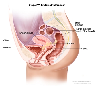 Stage IVA endometrial cancer shown in a side-view cross-section drawing of the uterus, bladder, cervix, vagina, small intestine, and large intestine. Cancer is shown in the bladder, uterus, and bowel.