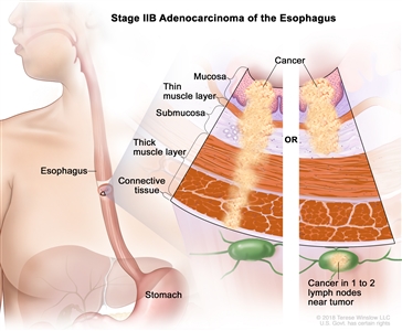 Stage IIB adenocarcinoma of the esophagus; drawing shows the esophagus and stomach. A two-panel inset shows the layers of the esophagus wall: the mucosa layer, thin muscle layer, submucosa layer, thick muscle layer, and connective tissue layer. The left panel shows cancer in the mucosa layer, thin muscle layer, submucosa layer, thick muscle layer, and connective tissue layer. The right panel shows cancer in the mucosa layer, thin muscle layer, and submucosa layer and in 1 lymph node near the tumor.