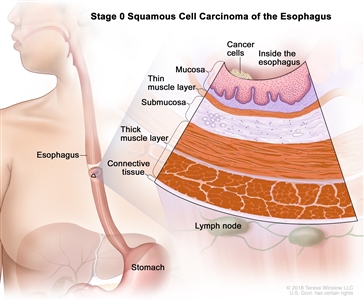 Stage 0 squamous cell carcinoma of the esophagus; drawing shows the esophagus and stomach. An inset shows cancer cells in the inner lining of the esophagus wall. Also shown are the mucosa layer, thin muscle layer, submucosa layer, thick muscle layer, and connective tissue layer of the esophagus wall. The lymph nodes are also shown.