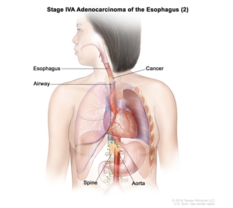 Stage IVA adenocarcinoma of the esophagus (2); drawing shows cancer in the esophagus, airway, aorta, and spine.