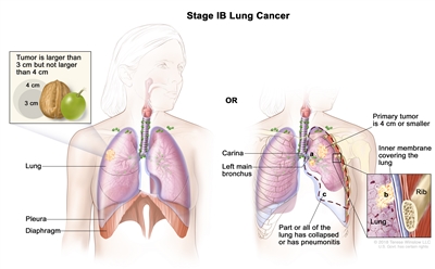 Two-panel drawing of stage IB lung cancer; the panel on the left shows a tumor (larger than 3 cm but not larger than 4 cm) in the right lung. Also shown are the pleura and diaphragm. The panel on the right shows a primary tumor (4 cm or smaller) in the left lung and cancer in (a) the left main bronchus and (b) the inner membrane covering the lung (inset). Also shown is (c) part or all of the lung has collapsed or has pneumonitis (inflammation). The carina and a rib (inset) are also shown.