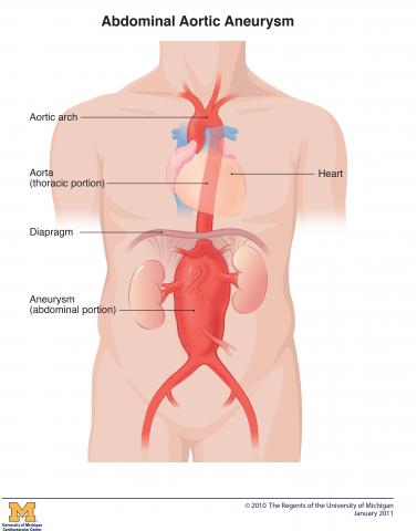 Illustruation of abdominal aortic aneurysm