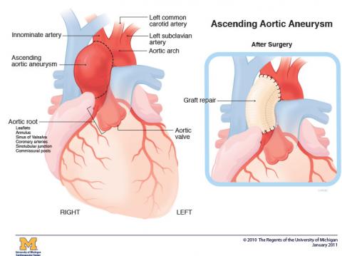 Illustration of ascending aortic aneurysm within heart before surgery and with repair and stitches after surgery