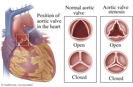 Illustration som visar aortaklaffens position i hjärtat, normal aortaklaff och aortaklaffstenos