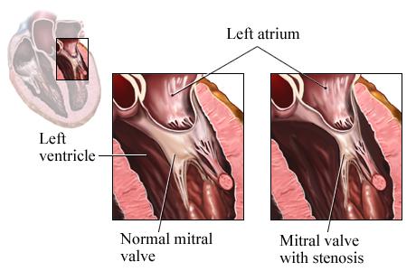 Illustration showing normal mitral valve and mitral valve with stenosis