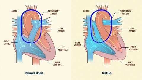 Learn about Congenital Heart Defects
