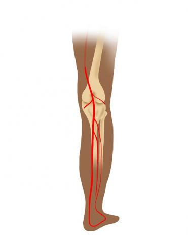 Illustration of lower leg showing compression of popliteal artery in bright red