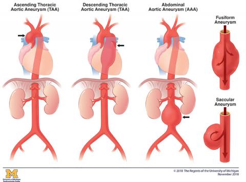 Illustration of 5 types of aneurysm: Ascending Thoracic Aortic Aneurysm (TAA), Descending Thoracic Aortic Aneurysm (TAA), Abdominal Aortic Aneurysm (AAA), Fusiform Aneurysm, Saccular Aneurysm